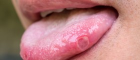 Oral Lesions: Oral Mucocele And Canker Sores
