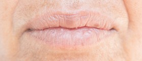Peeling Lips And Cheeks