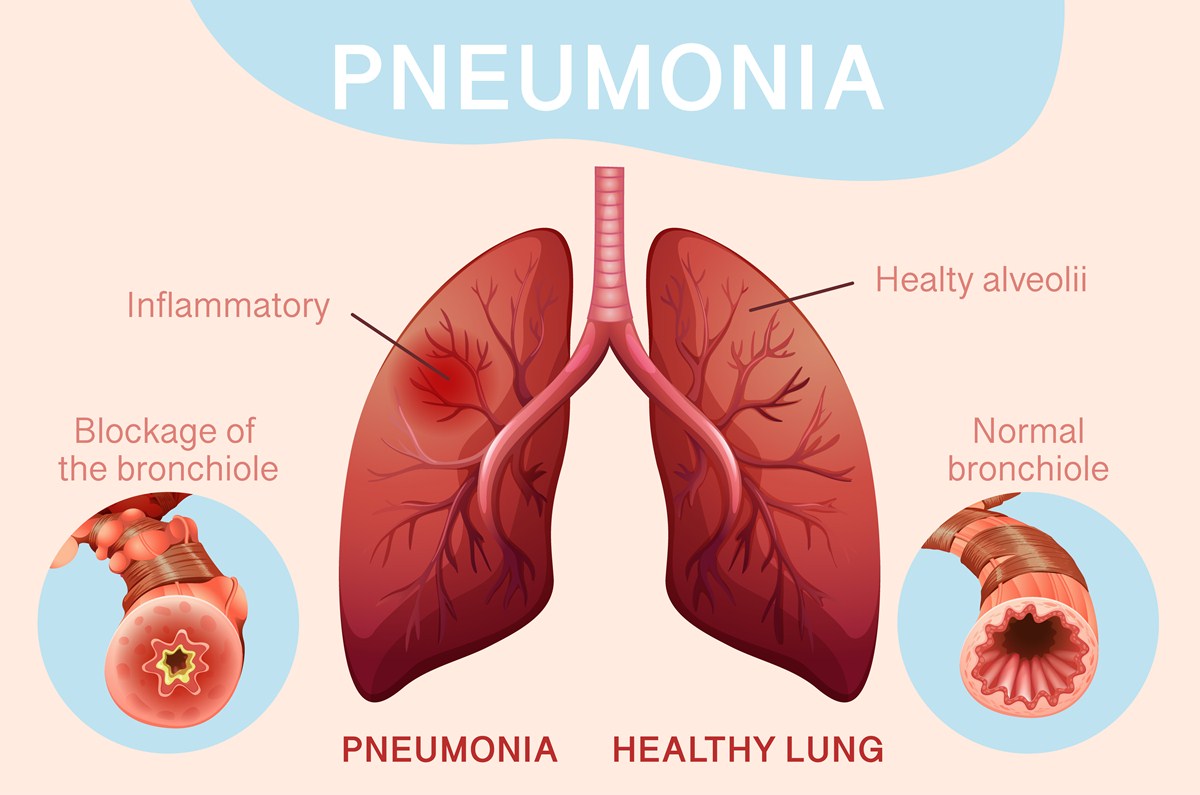 signs of pneumonia in lungs