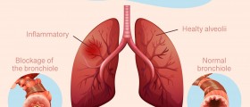 Pneumonia: Clinical Features, Treatment, and Complications