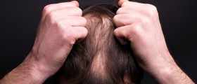 Poliosis: Localized White Patches Of Hair