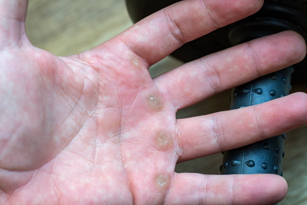 itchy-bumps-on-palm