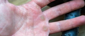 Possible Causes Of 'White Bumps' On Hands And Fingers