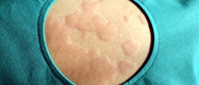 Pressure Urticaria: Triggers, Symptoms, And Treatment