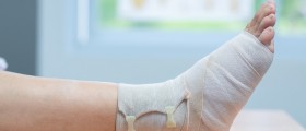 Reasonable Expectations After Lisfranc Fractures
