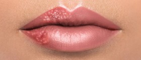 Recurrent Lip Infections