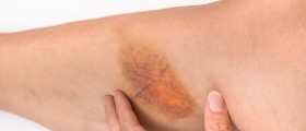 Resolving Hematoma