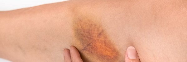 Resolving Hematoma