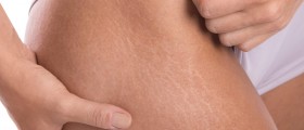 Scar-Like Marks On The Inner Thigh
