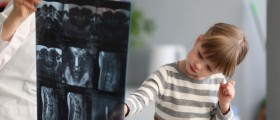 Scheuermann's Disease aka Kyphosis: What You Need To Know If Your Child Was Just Diagnosed