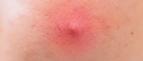 Sebaceous Prominence/ Fordyce Spots: An Overview