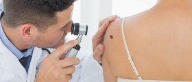 Should You Worry About A Growing Mole?