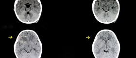 Subdural Hematoma Treatment: Do You Need Surgery?