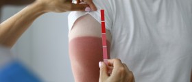 Sunburn Management: How to Minimize the Damage?