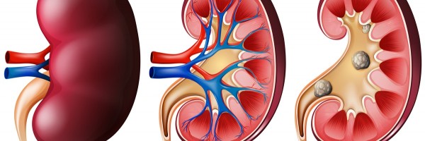 Supernumerary Kidney: An Extra Kidney