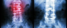 Surgery For Spondylolisthesis