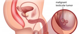 Testicular Cancer And Other Testicular Conditions