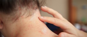 The Best Treatment For Seborrhoeic Dermatitis