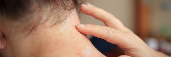 The Best Treatment For Seborrhoeic Dermatitis