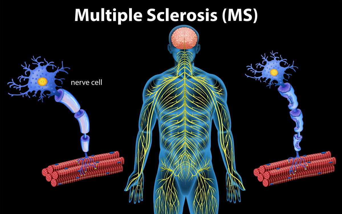 most common presentation of multiple sclerosis