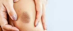 The Most Common Causes Of Bruising After Drinking Alcohol