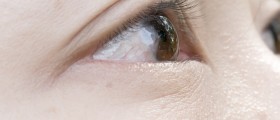 Treatment For Pinguecula And Pterygium