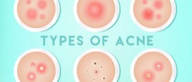Types And Causes Of Pimples