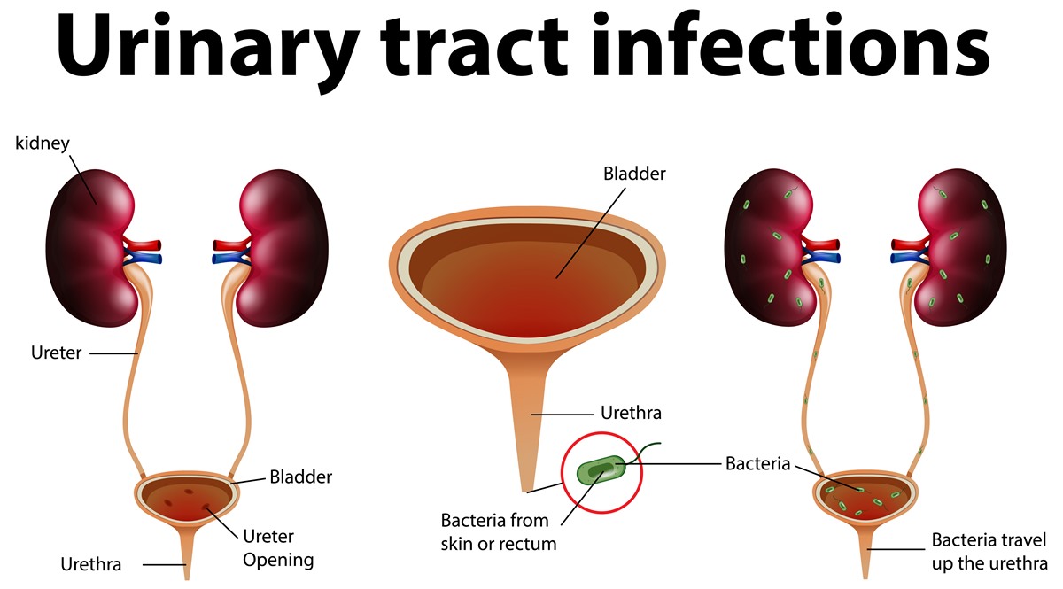 Urinary Tract Infections Symptoms Diagnosis And Treatment Urinary Tract Issues Medical 5040