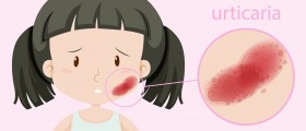 Urticaria: Why Do Hives Appear?