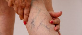 Varicose Veins Symptoms, Causes And Treatments