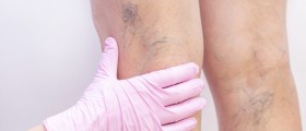 Visible Veins Are Nothing To Worry About, If They Are Not Associated With Other Symptoms