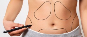 Weight Gain After Tummy Tuck