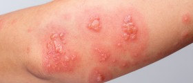 What Are Ganglion Cysts?