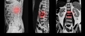 What Can You Do to Relieve Pain after Disc Fusion?