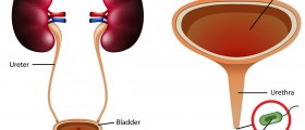 What Can You Expect After Ureteral Reimplant Surgery?