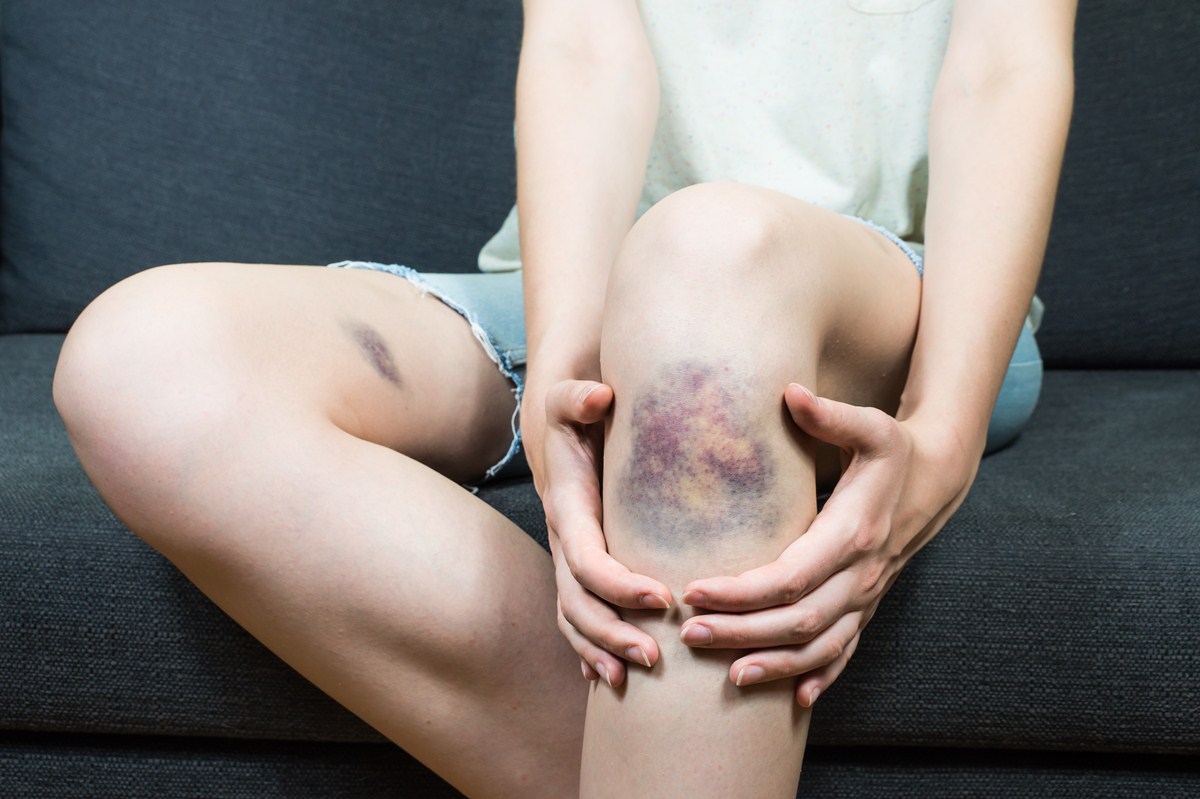 What Causes Easy Bruising? | Cardiovascular Disorders and Diseases medical  answers | Body & Health Conditions center | SteadyHealth.com