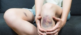 What Causes Easy Bruising?