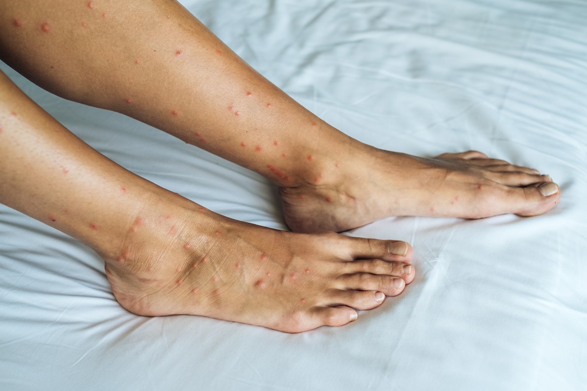 dark-spots-on-legs-what-s-the-cause-and-how-to-treat-them-2022