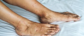 What Causes Red Spots On Legs?