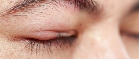 What Is A Chalazion?