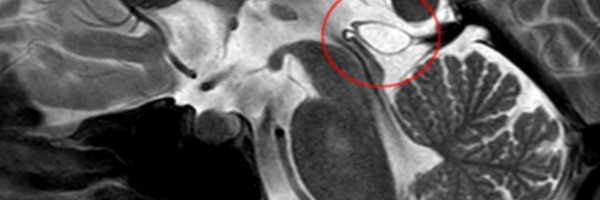 What Is A Pineal Cyst?