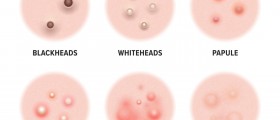 What is Steatocystoma Multiplex?