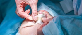 What To Expect From Rhinoplasty