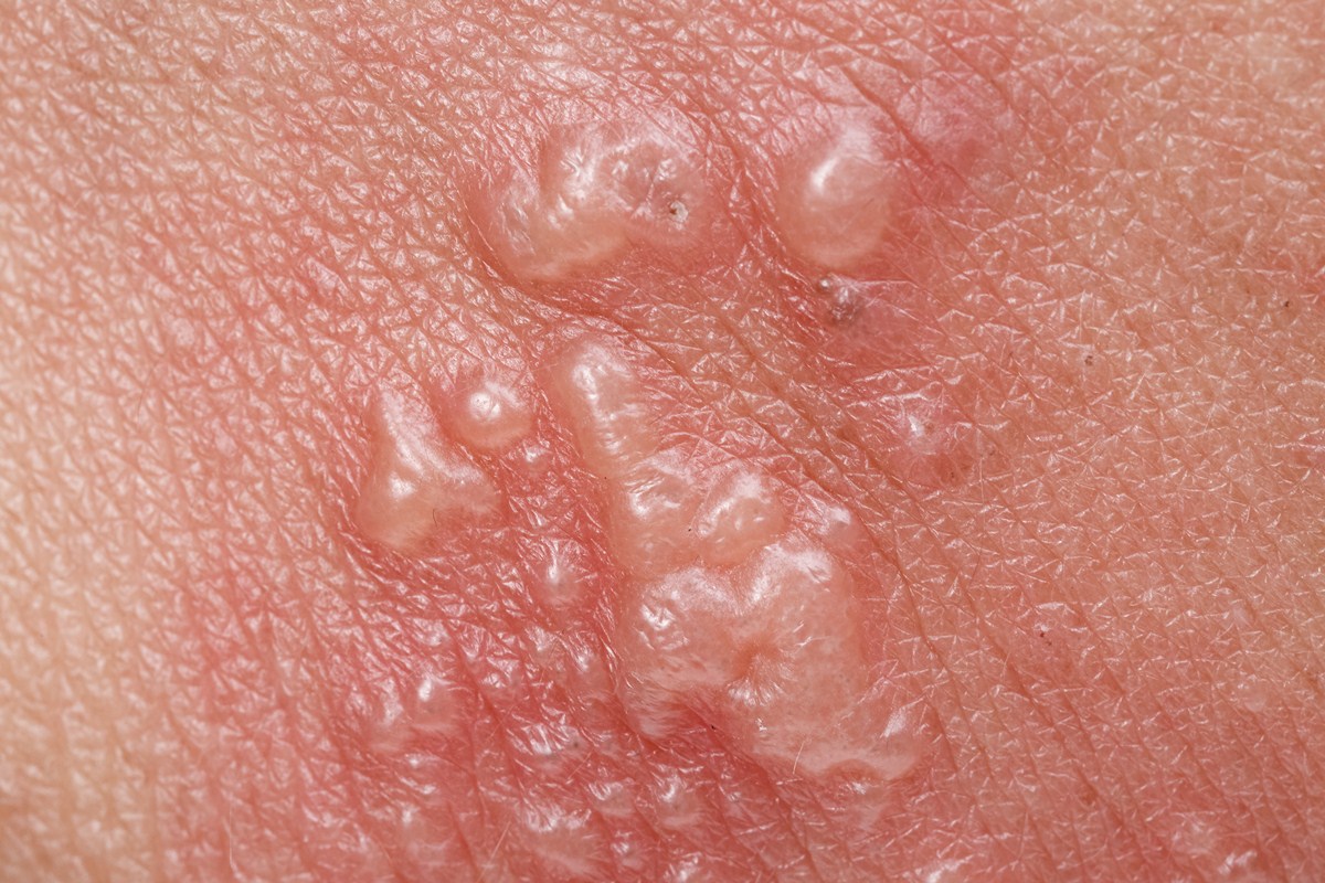 Anus hole near pimple Bowel Disorders: