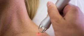 When Should You Consider Mole Removal?