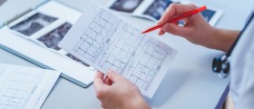 Wolff Parkinson White Syndrome And EKG