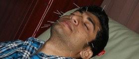 7 Ways Acupuncture Can Change Your Life For The Better