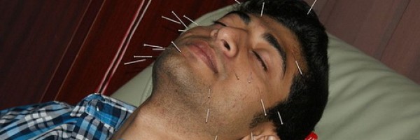 7 Ways Acupuncture Can Change Your Life For The Better