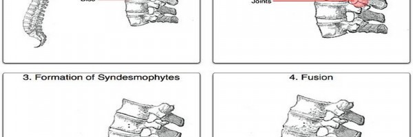 Beware Of Ankylosing Spondylitis : Maybe You Are It's Next Victim