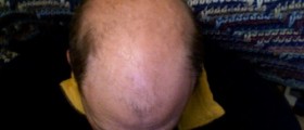 The Most Common Hair Disorders